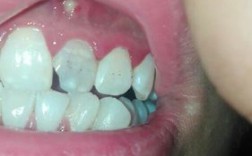 牙房上有白色点（牙齿上有白色点点是什么）