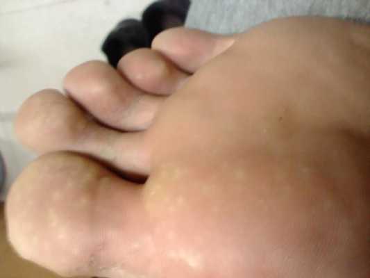 大脚趾长白色花纹（大脚趾上有白色斑点）-图1
