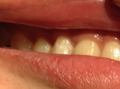 牙房上有白色点（牙齿上有白色点点是什么）-图2