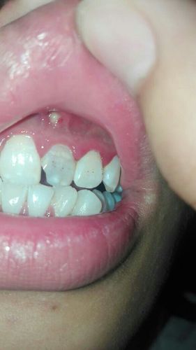 牙房上有白色点（牙齿上有白色点点是什么）-图1
